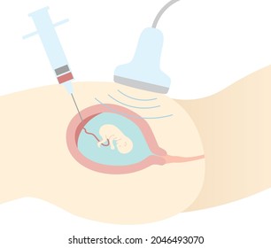 Prenatal diagnosis. Chorionic villus test. An illustration of a pregnant woman's stomach seen from the side. Flat design.
