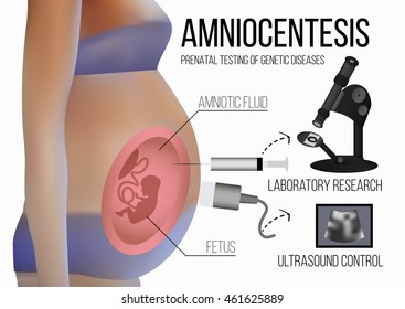 Prenatal diagnosis of chromosomal abnormalities. Amniocentesis. Pregnant woman. Ultrasound control. Genetic diseases. Vector illustration isolated on white background.