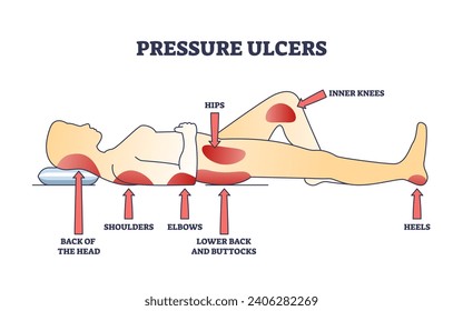 Pressure ulcers or bedsores skin tissue injuries locations outline diagram. Labeled educational scheme with stationary laying patient caused dermatological conditions on body vector illustration.