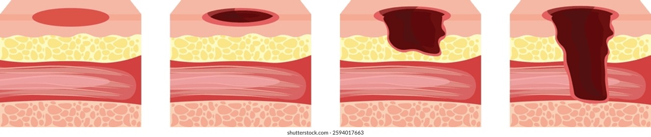 Pressure ulcers formation on bony parts of the body, such as the heels, elbows, hips and tailbone.