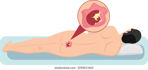 Pressure ulcers formation on bony parts of the body, such as the heels, elbows, hips and tailbone.