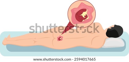 Pressure ulcers formation on bony parts of the body, such as the heels, elbows, hips and tailbone.