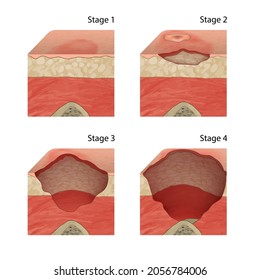 Pressure ulcers. Injuries to the skin and underlying tissue caused by prolonged pressure on the skin. Vector medical illustration.