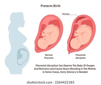 Preterm birth. Placental abrupted and early baby delivery. Pregnancy pathology. Flat vector illustration