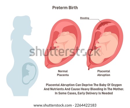 Preterm birth. Placental abrupted and early baby delivery. Pregnancy pathology. Flat vector illustration