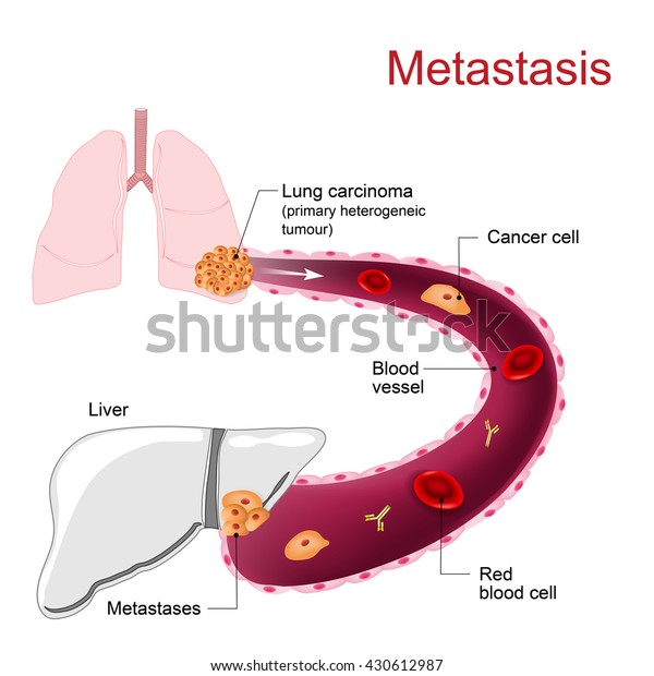Primary lung
cancers metastasize to the
liver.