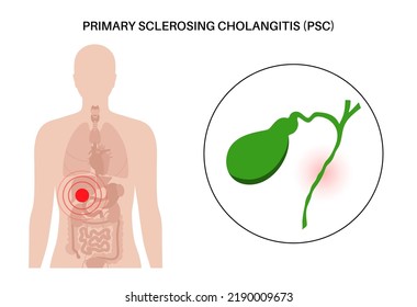 Primary Sclerosing Cholangitis Concept. PSC Gallbladder Disease.Abdomen Pain In The Human Body. Inflammation In The Digestive System. Internal Organ Examination In Clinic. Medical Vector