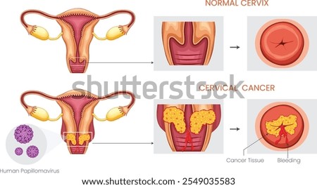 The primary vector for cervical cancer is the human papillomavirus (HPV), which spreads through sexual contact.