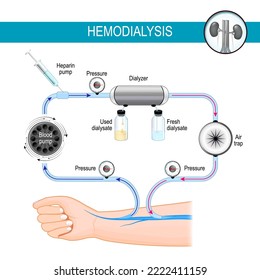 El principio de la máquina de hemodiálisis. Proceso de diálisis. la hemodiálisis está desviando sangre hacia una máquina externa, donde se filtra antes de ser devuelta al vaso sanguíneo. ilustración vectorial