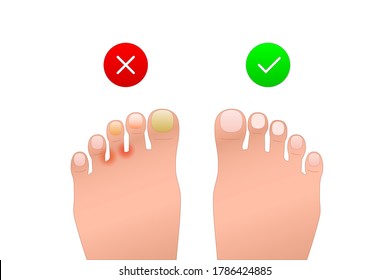 problem and healthy foot icon. representation patient’s feet with allergic, dermatitis, unguium. image of skin disease and rash. symbol for medical sites, apps. simple color sign isolated on white