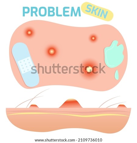 Problem skin with acne side and top view