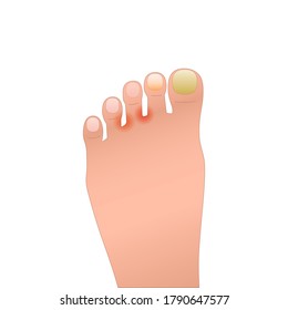 problematische Haut und Fußnägel. Repräsentation der Füße des Patienten mit Allergie, Dermatitis, unguium. Hautkrankheiten und Hautausschlag. Symbol für medizinische Stätten, Apps. einfaches Farbzeichen einzeln auf Weiß
