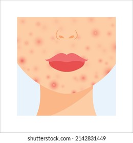 Problem Skin on Female Face. Acne. Pimples on Chin and Cheeks. Close up view. Part of face. Unhealthy skin with a Red Rash. Cartoon style. White background. Vector image for Beauty and Medical design.