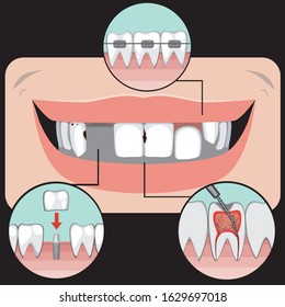 Problems with molars on a black background as a concept for treating pulpitis with an orthodontist. Vector stock illustration with infographics with a smile, caries, implant and braces for design.