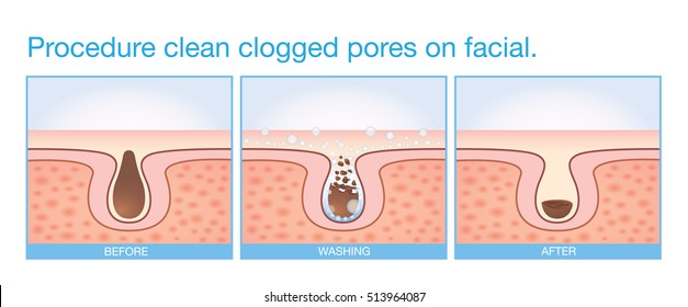 Procedimento limpo poros entupidos no rosto. Ilustração sobre beleza e cuidados com a pele.