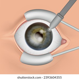 The procedure of an eye surgery. Anatomy of the eye