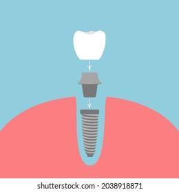 Procedure for implanting in scheme
