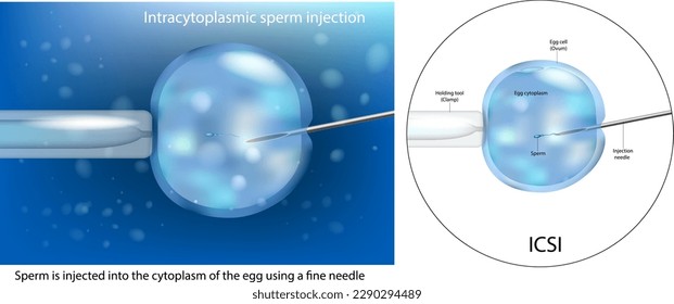 The procedure of Intracytoplasmic sperm injection ICSI. Artificial insemination in vitro fertilization. IVF macro. Scientific Diagram