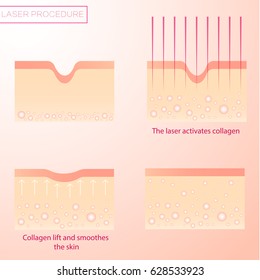 Procedure Of Laser Rejuvenation. Lifting And Resurfacing Of The Skin.cosmetology  Alignment Of Wrinkles.