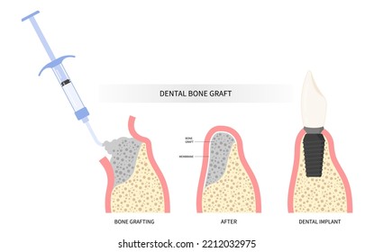 Procedure of Teeth bone Graft surgery