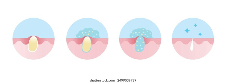 Process of acne pimple treatment vector icon set illustration. Apply salicylic acid on whitehead, penetrate into skin to dissolve closed plugged pore the dead skin cell, sebum and keeping pore clear.