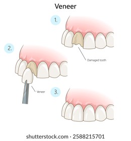 process of applying dental veneer to repair a damaged tooth, showing step-by-step cosmetic dental restoration diagram hand drawn schematic vector illustration. Medical science educational illustration