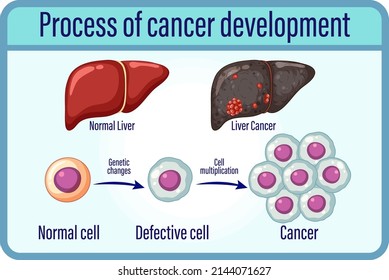 Process of cancer development illustration