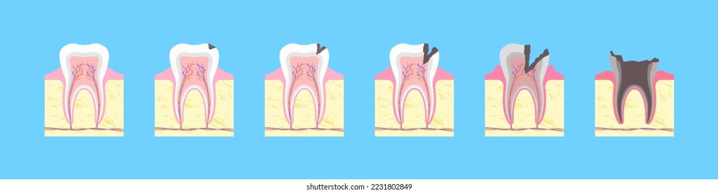 Process of carious destruction of tooth. Healthy bone formation with black fissure and gradual inflammation. Enamel decay with dental infection and complete vector loss