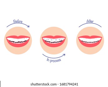 The process of correcting teeth using braces - before and after. Vector illustration