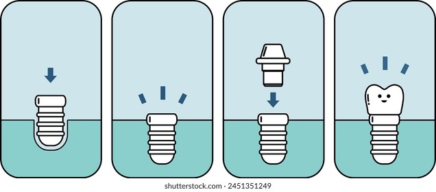 The process of dental implant - flat illustration 