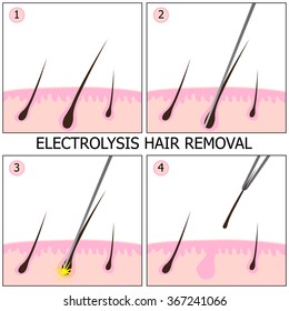 process electrolysis hair removal 260nw 367241066