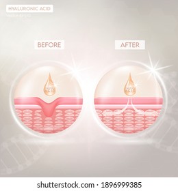 Process of getting skin younger with help of hyaluronic acid before and after skin solutions ad, orange collagen serum drop with cosmetic advertising background. Vector EPS10