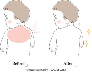 
The process of healing a baby with a sunburn on his back