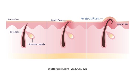 The process of Keratosis Pilaris vector illustration isolated on white background. Cross section of Keratin plug, Ingrown hair, Chicken skin and Bumpy skin. Atopic Dermatitis Infographic.