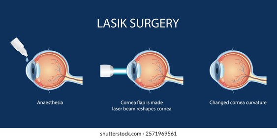 The process of laser eye surgery LASIK. Vision correction for nearsightedness, farsightedness, and astigmatism.