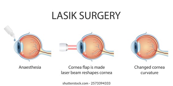 The process of laser eye surgery LASIK. Vision correction for nearsightedness, farsightedness, and astigmatism.