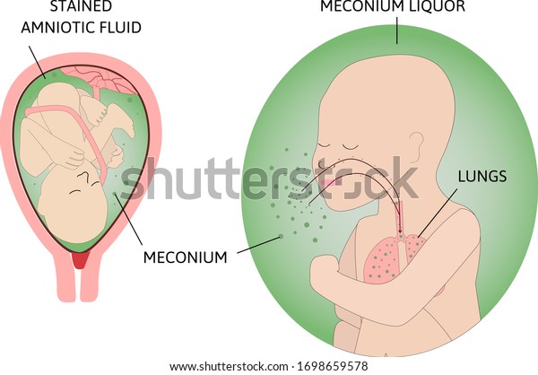 胎便吸引症候群の過程で 胎便の新生児誤嚥 胎内の胎児 彼の周りにメコニウム 子どもは緑羊水で呼吸をする 行とタイトルでマークされる ベクター画像 のベクター画像素材 ロイヤリティフリー