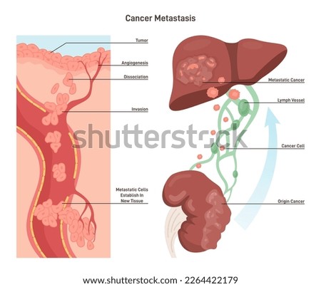 Process of metastasis. Formation of tumor in a tissue of secondary organ. Cancer cells migrating by blood or lymph vessels. Flat vector illustration