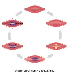 Process of muscle's stiffness and pain / circle type illustration (no text)