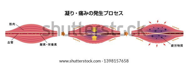 Process Muscles Stiffness Pain Illustration Japanese: Stock ...