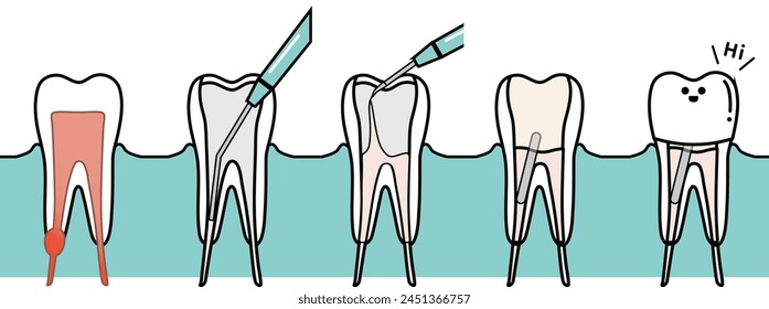 the process of root canal treatment, dental treatment  - flat illustration 