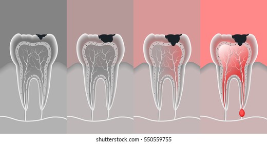 Process Teeth Problem With Vector