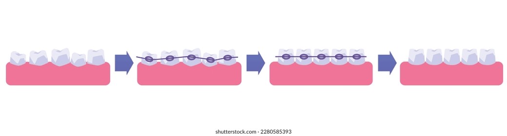 Process of teeth straightening with dental braces, flat vector illustration isolated on white background. Crooked teeth before and after orthodontic cases. Concept of dental care.