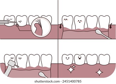 el proceso de cirugía dental y regeneración ósea guiada - ilustración plana 