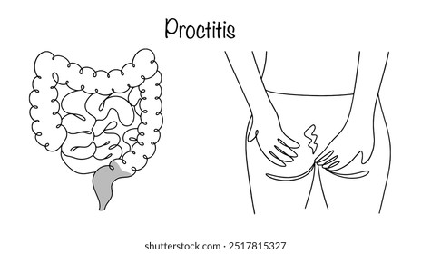 Proctite. Inflamação da mucosa retal. A doença se manifesta por uma sensação de desconforto no reto e distúrbios nas fezes. Ilustração vetorial.