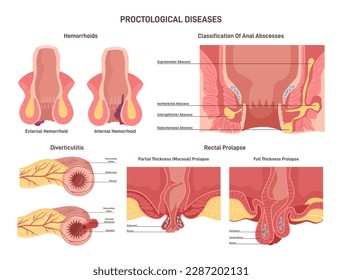 Enfermedades proctológicas establecidas. Trastornos del intestino grueso y del recto. Hemorroides, abscesos y prolapso. Anatomía de corte transversal del ano humano con esfínter, músculos y venas. Ilustración vectorial plana