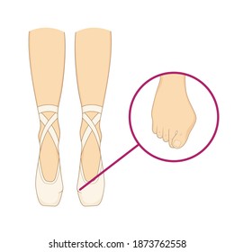 Professional ballerinas bunion illness. The dancers legs are barefoot and in pointes vector illustration. Orthopedics hallux valgus