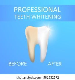 Professional Teeth Whitening, Healthy And Yellow Tooth, Vector Illustration