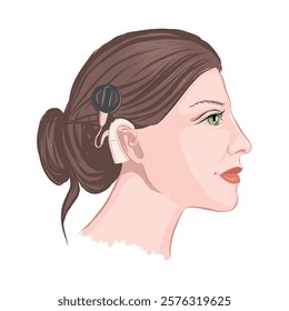 Profile of a girl with a cochlear implant. Concept of surgery for people with hearing loss. Vector illustration