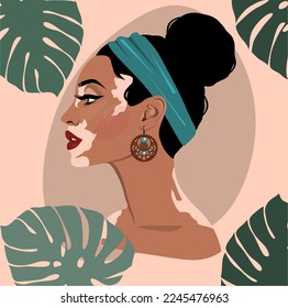 Profile portrait of an woman with vitiligo skin. African casual woman with vitiligo. Body positive concept. World vitiligo day June 25. Vector flat isolated illustration.